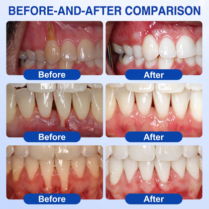 🇿🇦Pureluxo® 🦷  periodontal repair gel 🧑‍⚕️