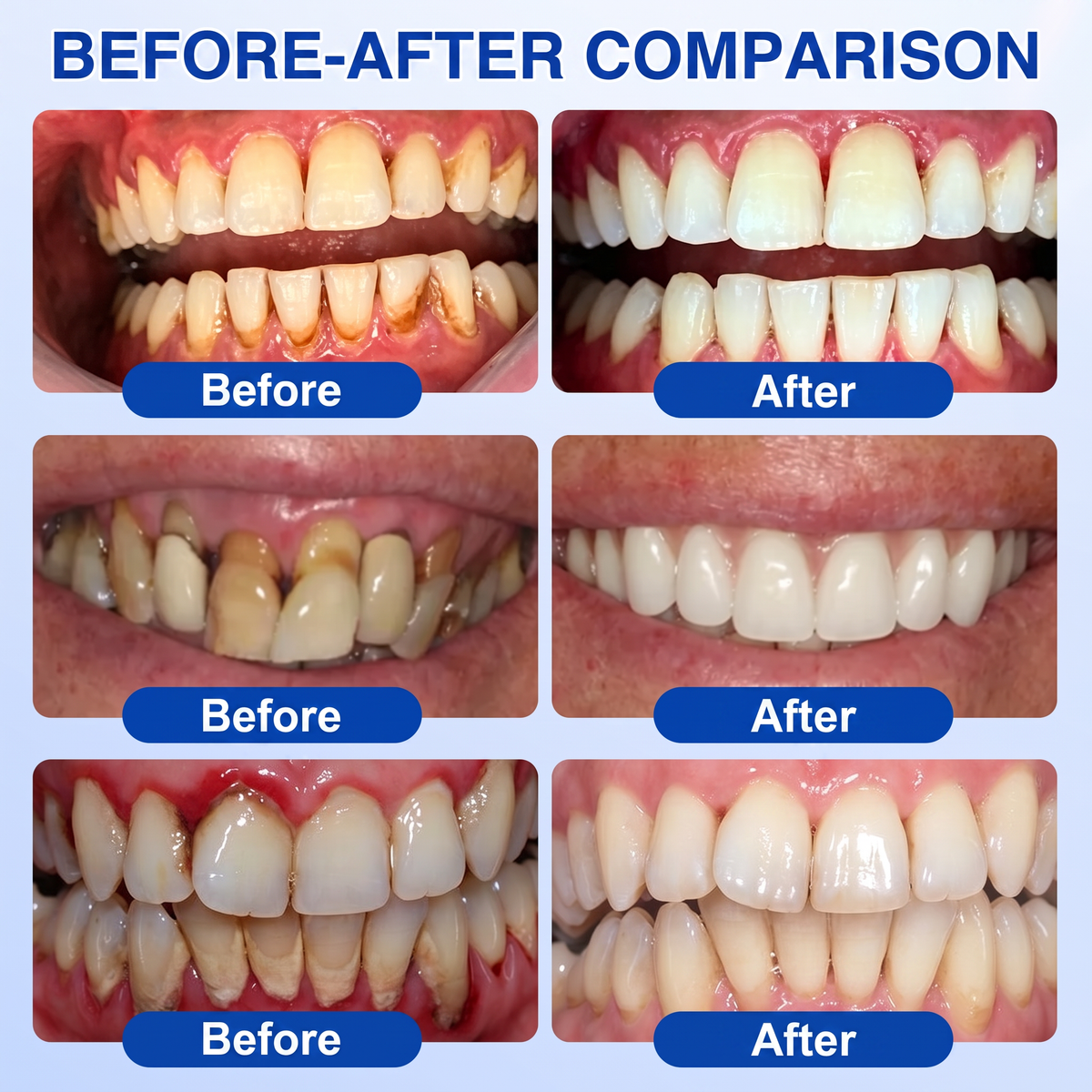 🇿🇦Pureluxo® 🦷  periodontal repair gel 🧑‍⚕️